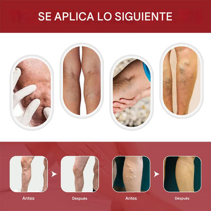 Crema para desvanecer las varices